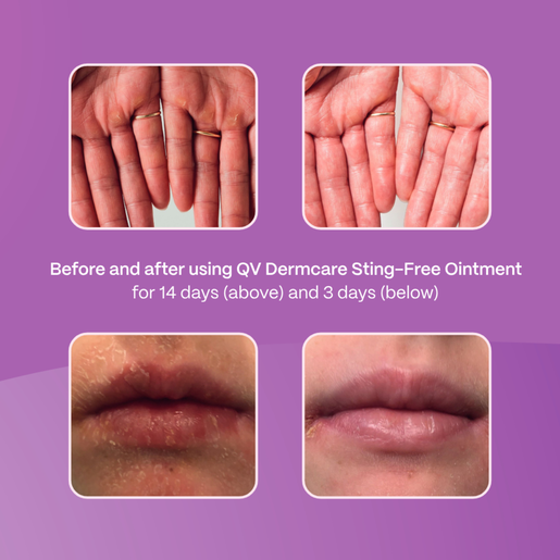 QV Dermcare Sting-Free Ointment 200gm